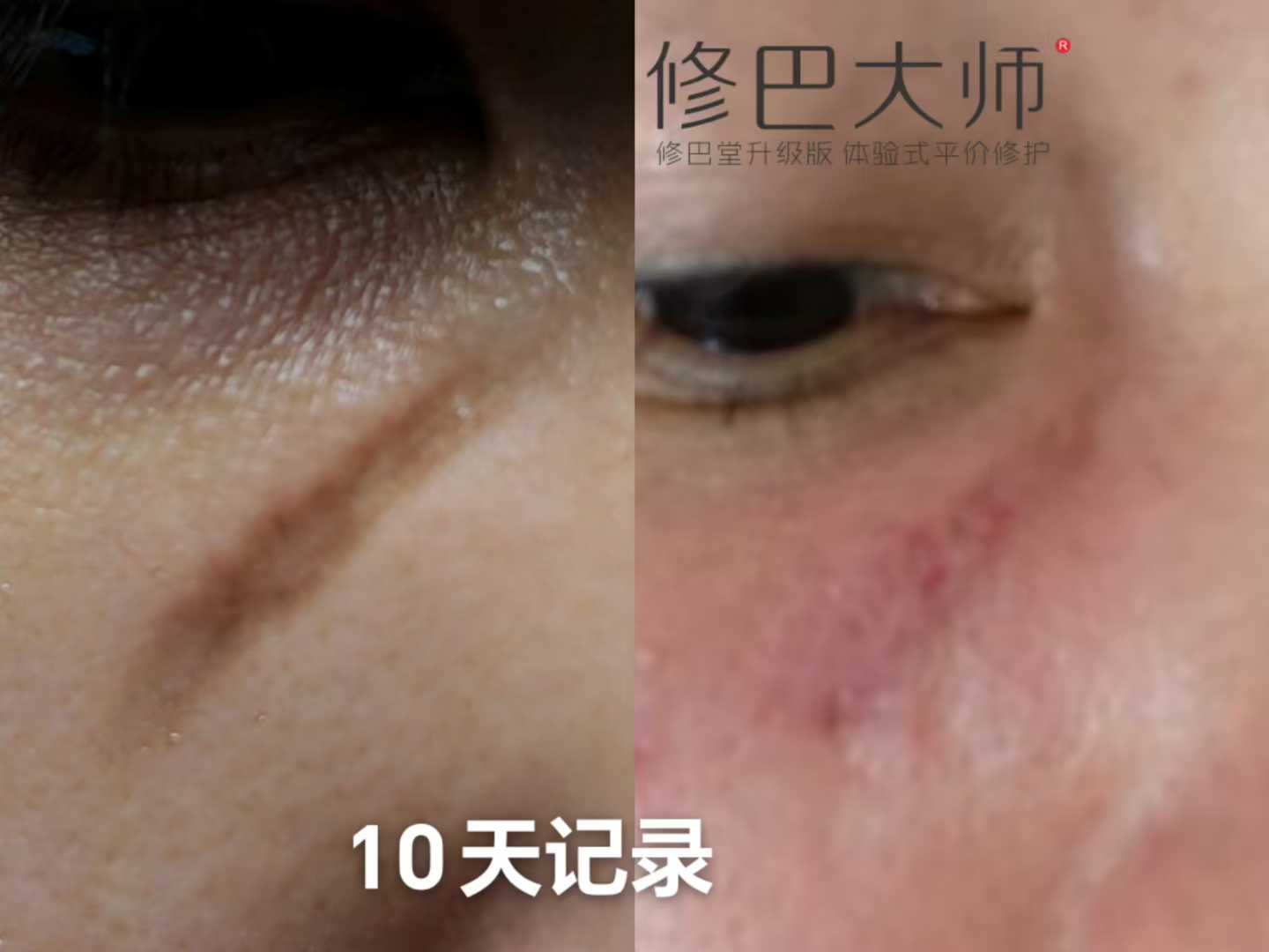 疤痕修复10天记录
